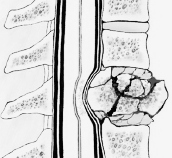 fracture fracture