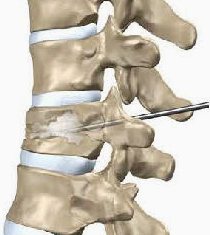 vertebroplastica vertebroplastica